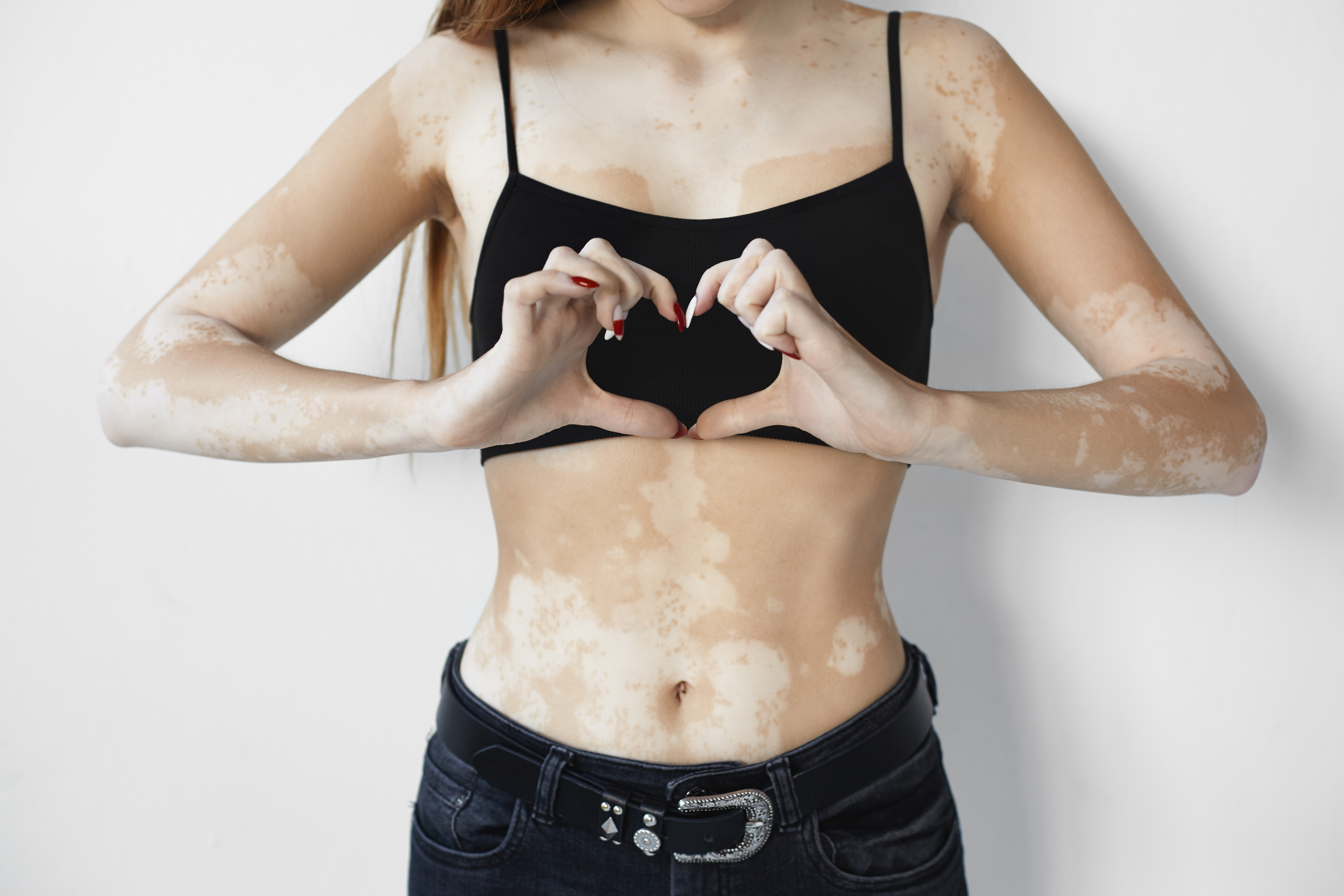 Vitiligo Ayurvedic treatment